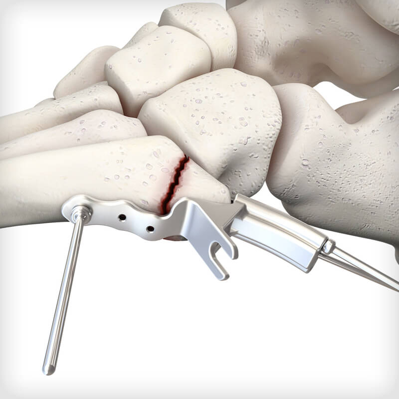 5th Metatarsal Hook Plates