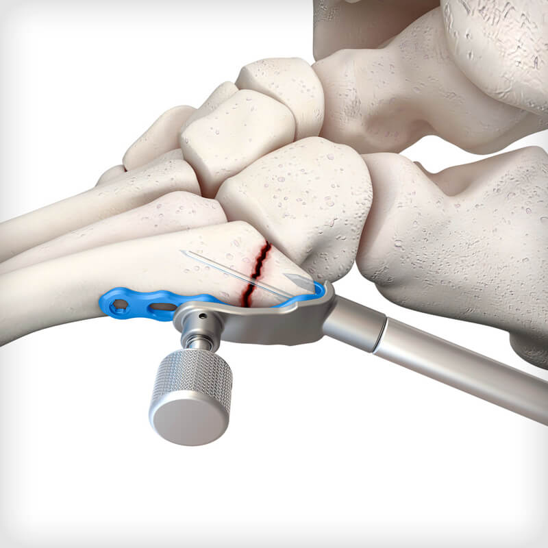 5th Metatarsal Hook Plates