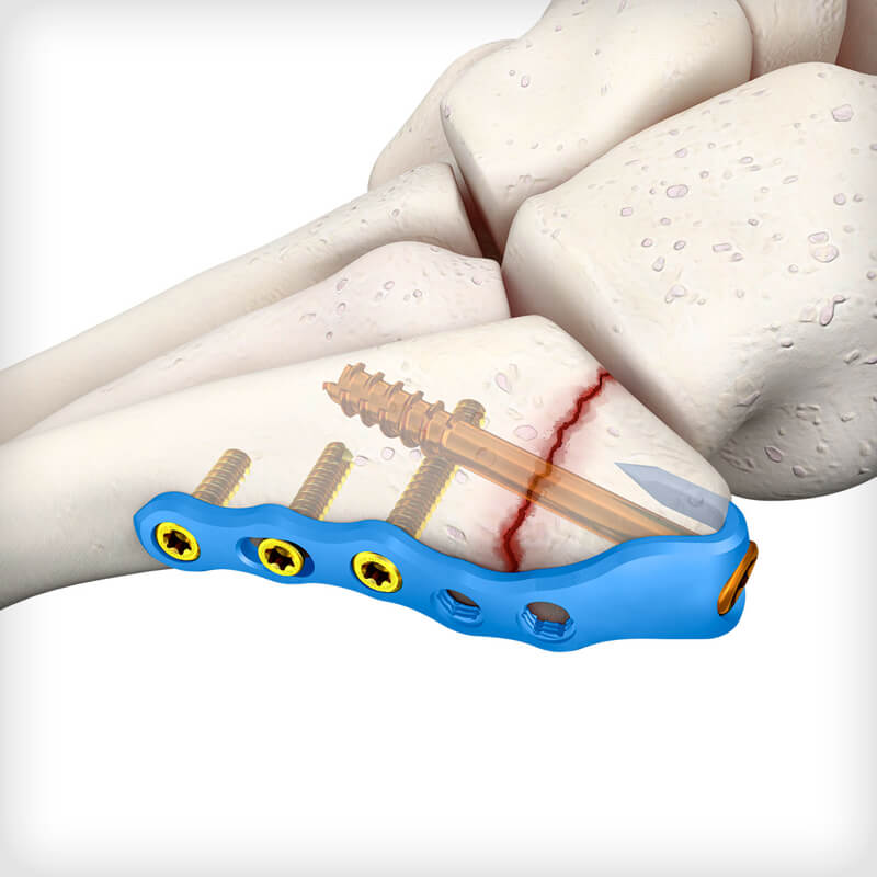 5th Metatarsal Hook Plates