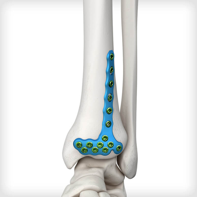Anterolateral Distal Tibia Plates