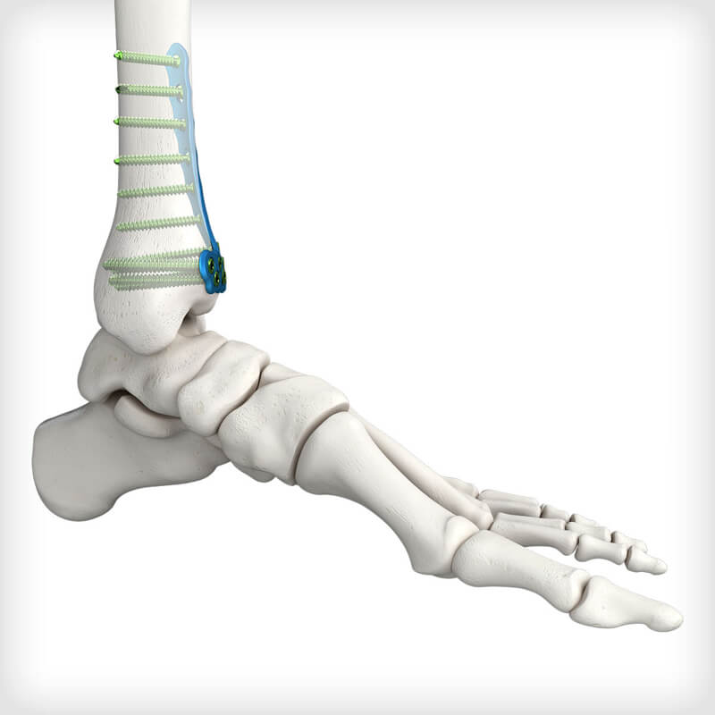 Anterolateral Distal Tibia Plates