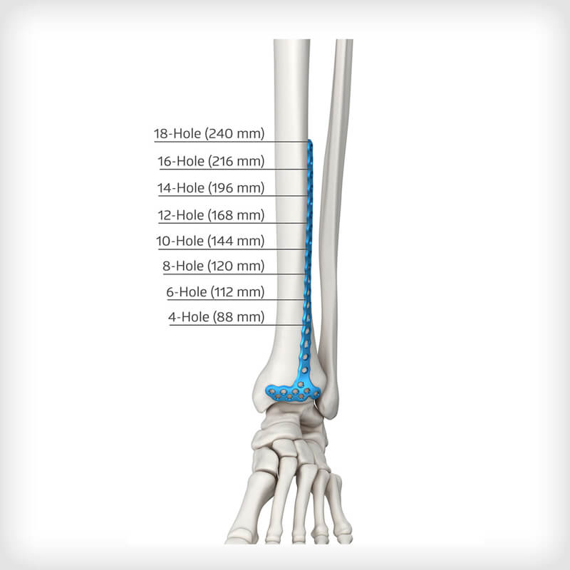 Anterolateral Distal Tibia Plates
