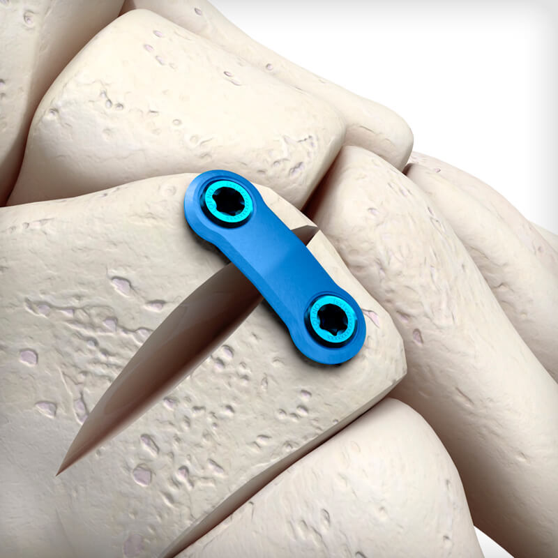 Cotton Osteotomy Plate