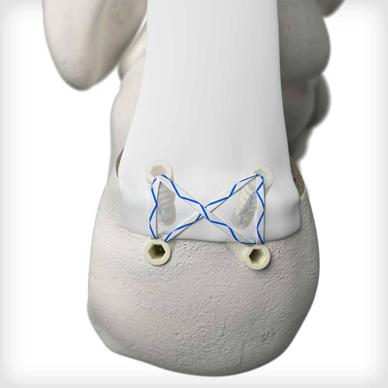 DEXLOCK KNOTLESS Suture Anchors