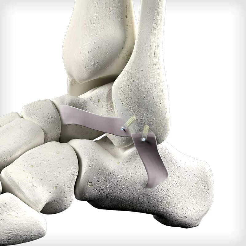 DEXTACK PUSH Suture Anchors