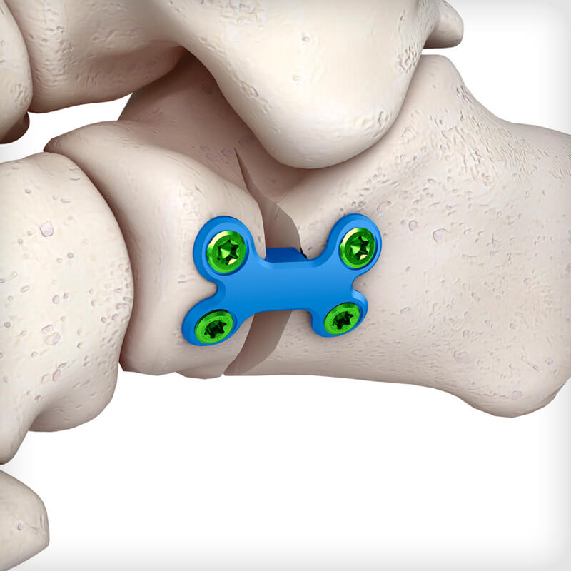 Evans Osteotomy Plates