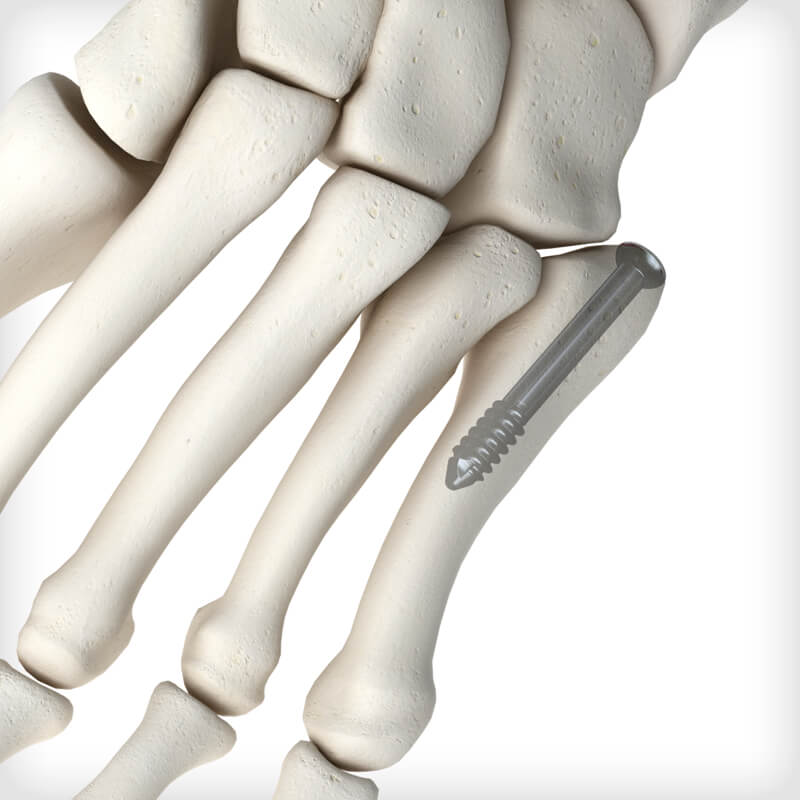 Jones Fracture Screws
