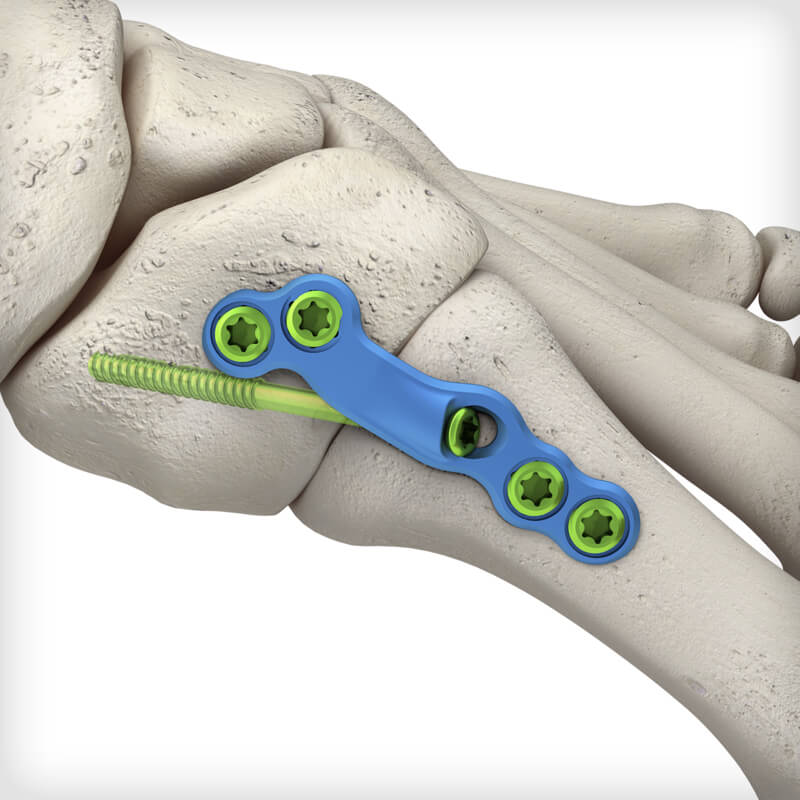 Lapidus Dual-Mode Compression