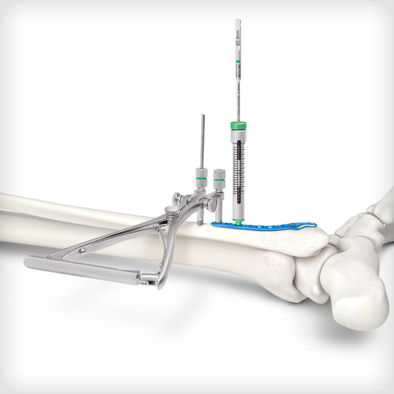 Lateral Fibula Plates