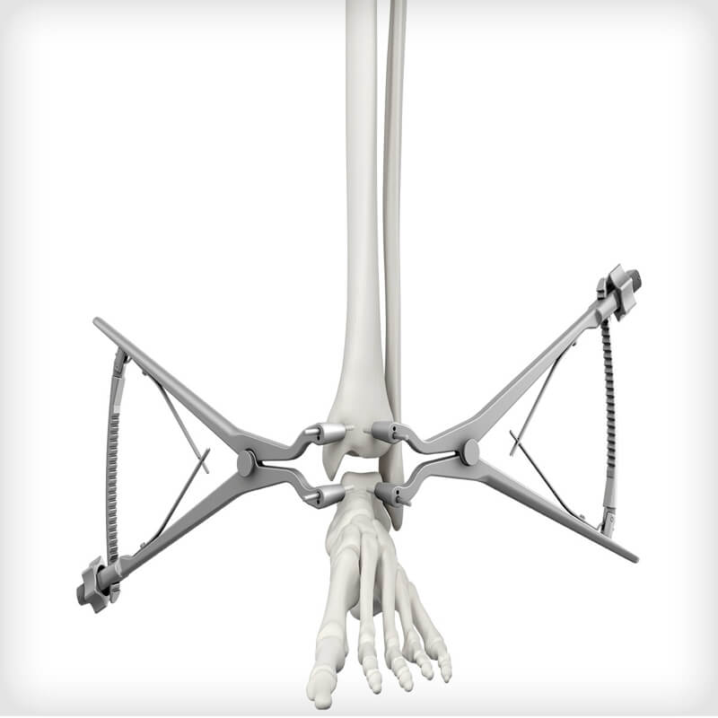 Lateral TTC Fusion Plates