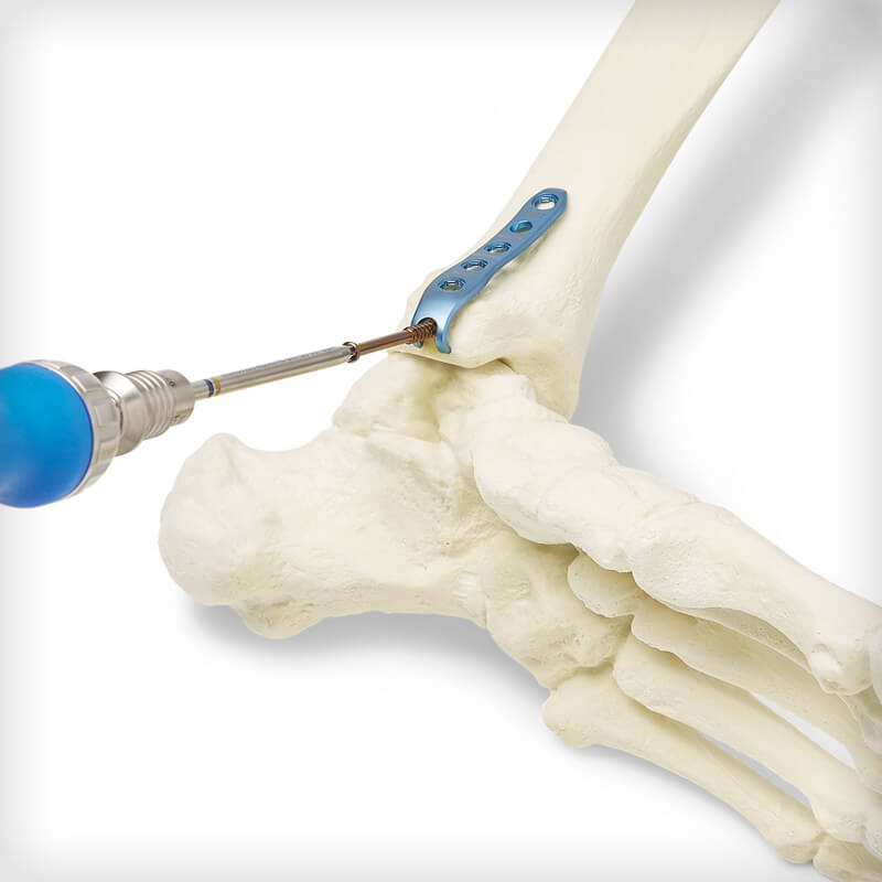 Malleolar Hook Plates