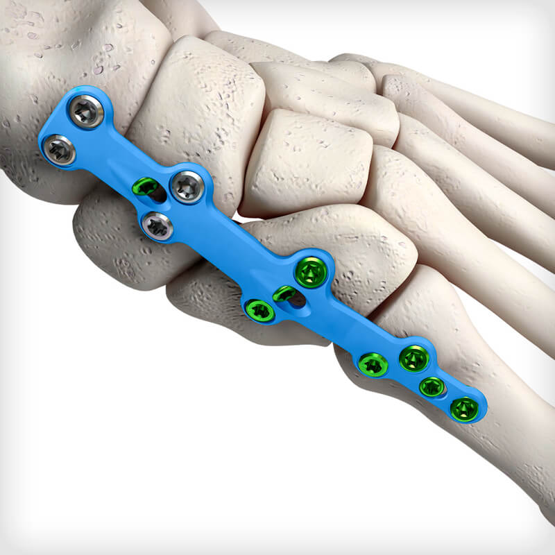Medial Column Fusion Plates