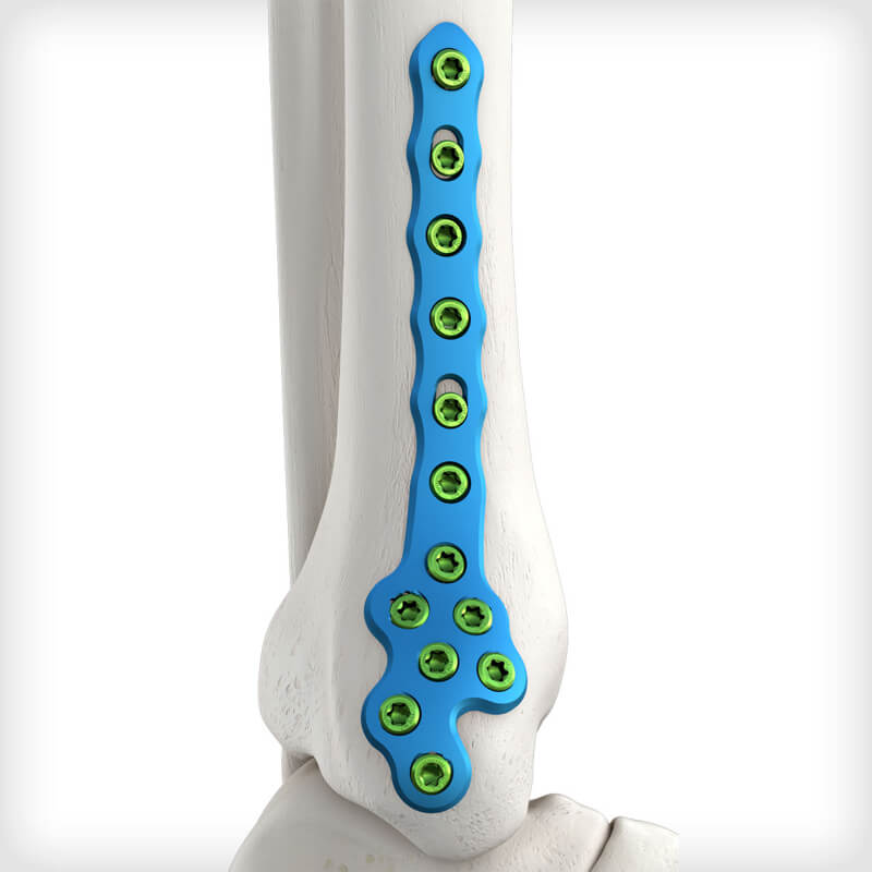 Medial Distal Tibia Plates