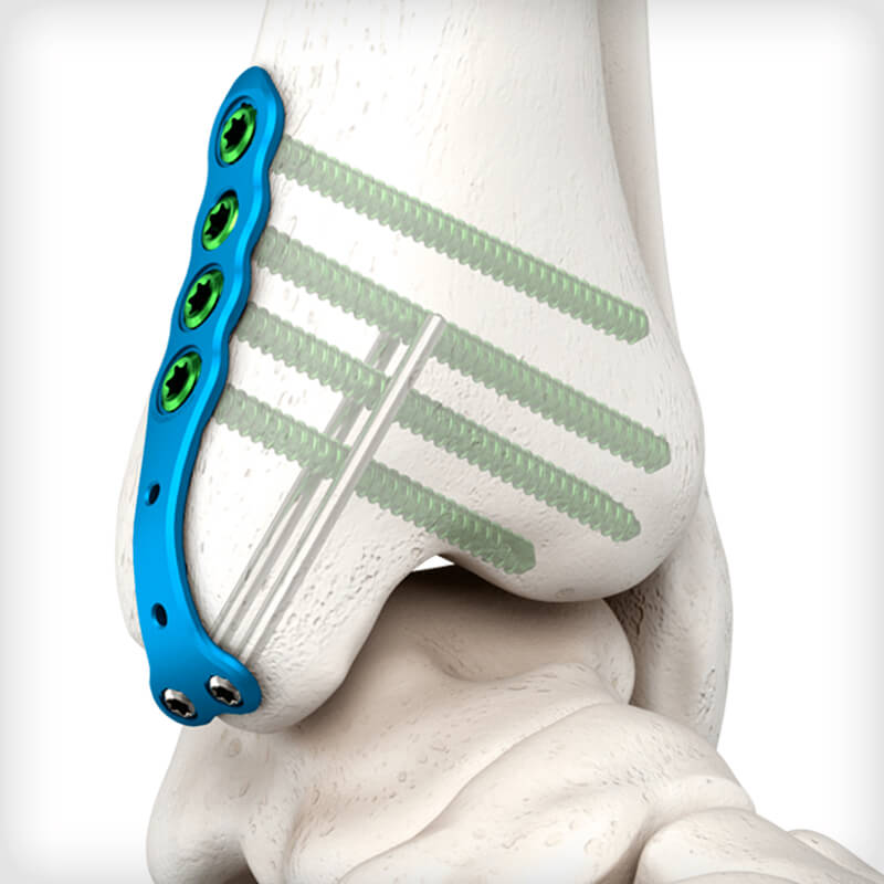 Medial Mal Peg Plates