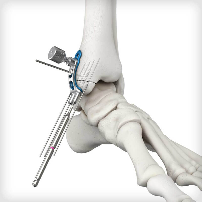 Medial Mal Peg Plates