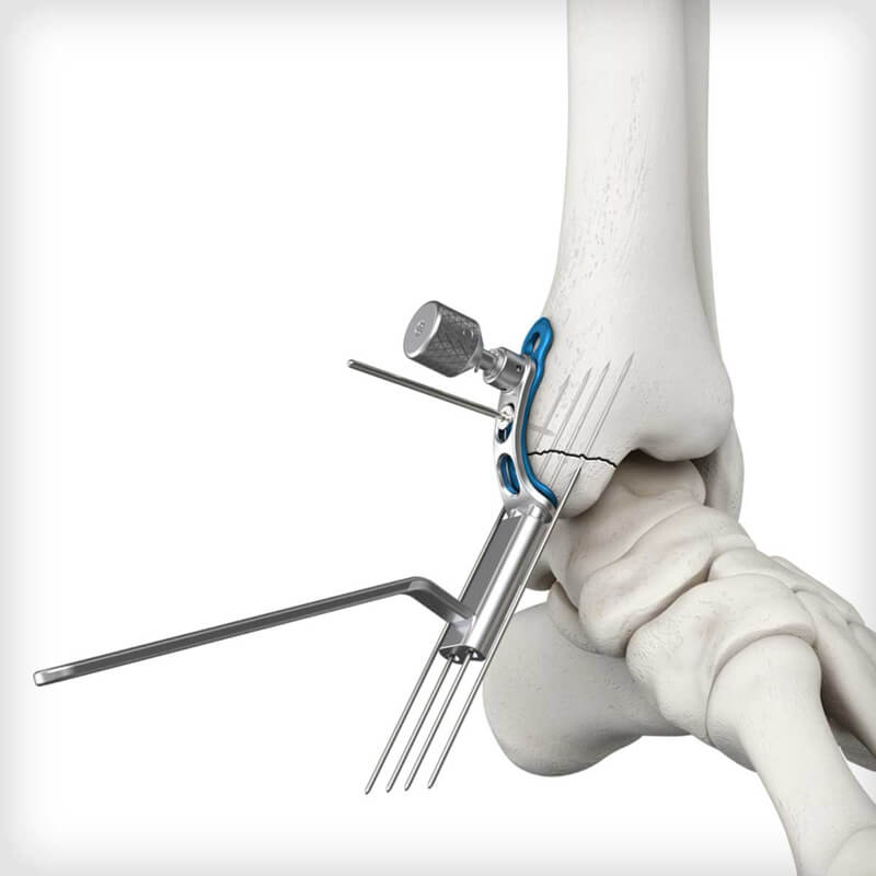 Medial Mal Peg Plates