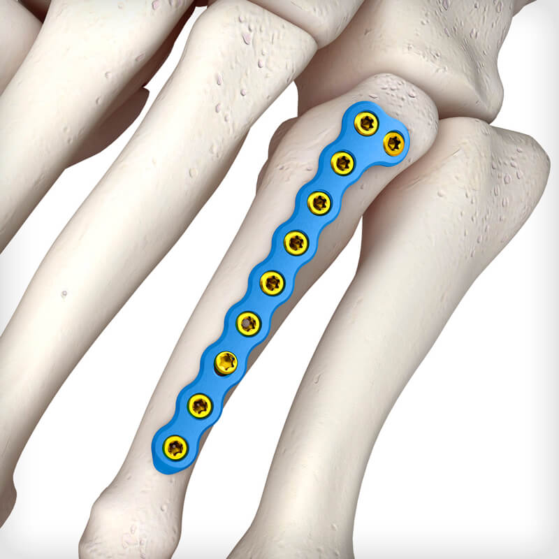 Metatarsal L Plates