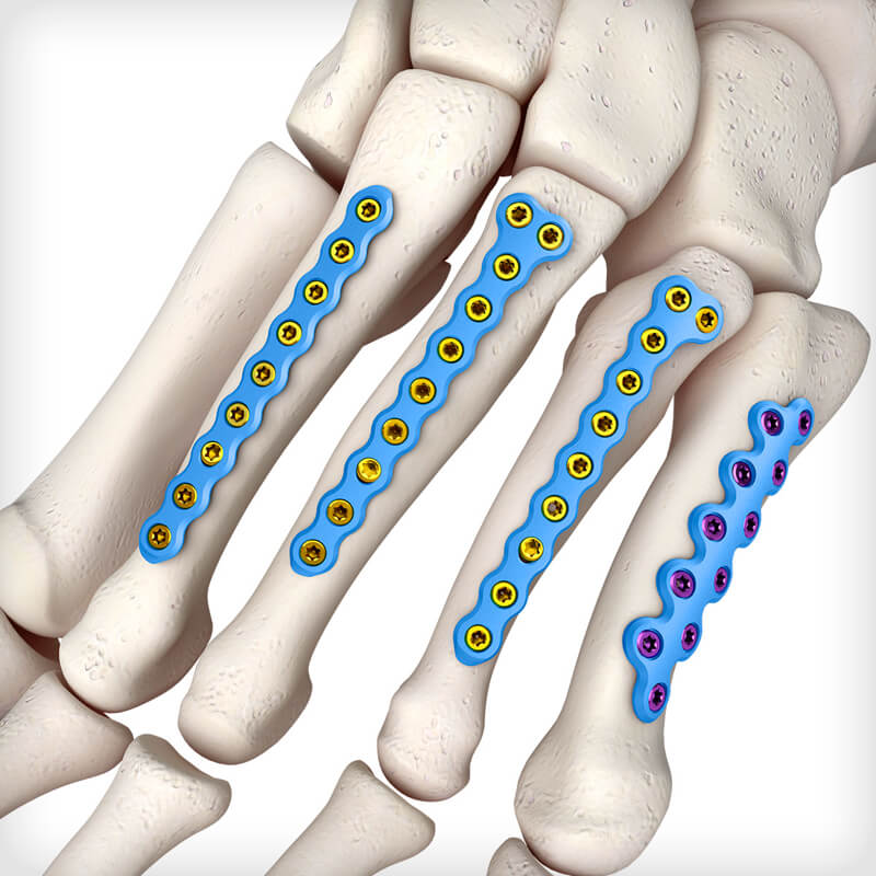 Metatarsal L Plates