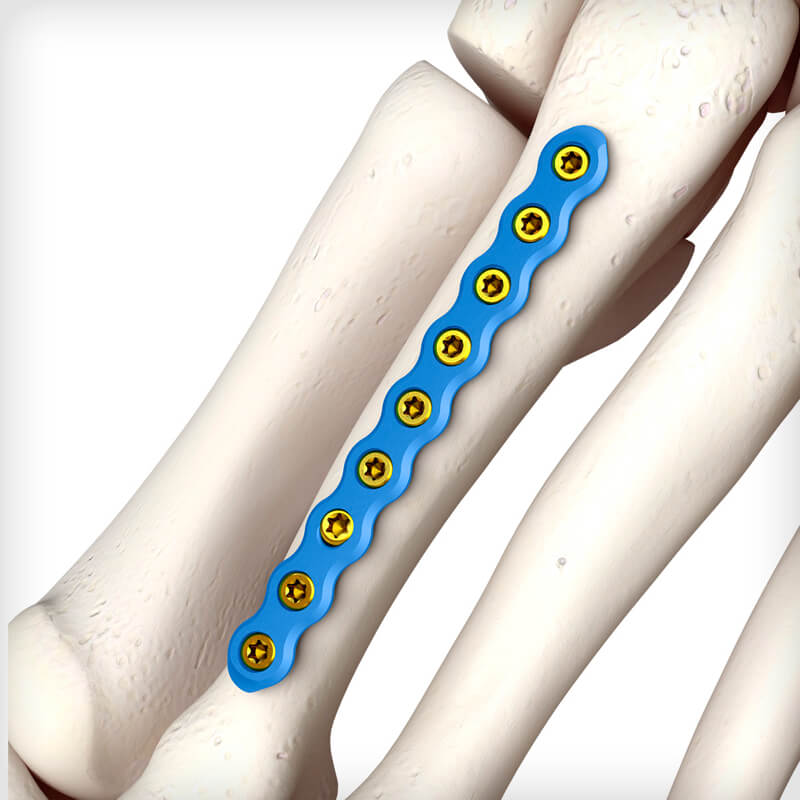 Metatarsal Straight Plates