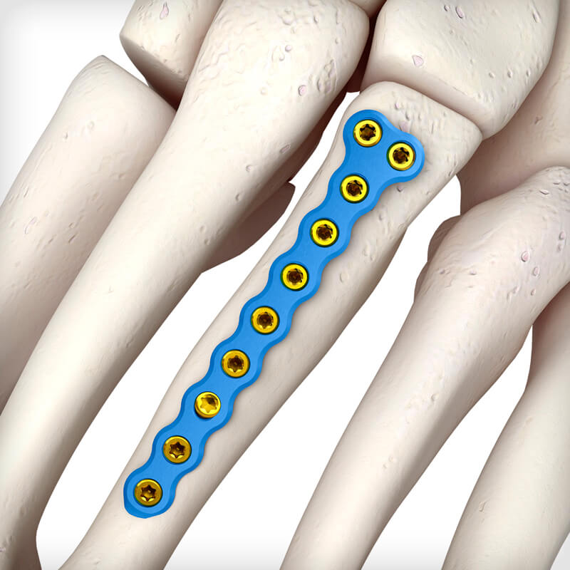 Metatarsal T Plates
