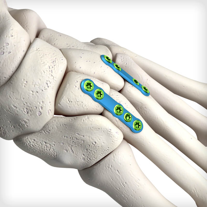 Midfoot Fusion Straight Plates