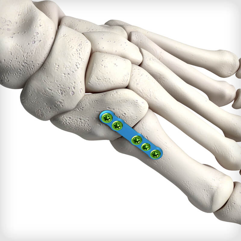 Midfoot Fusion Straight Plates