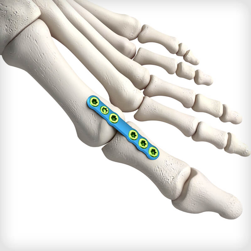 Midfoot Fusion Straight Plates