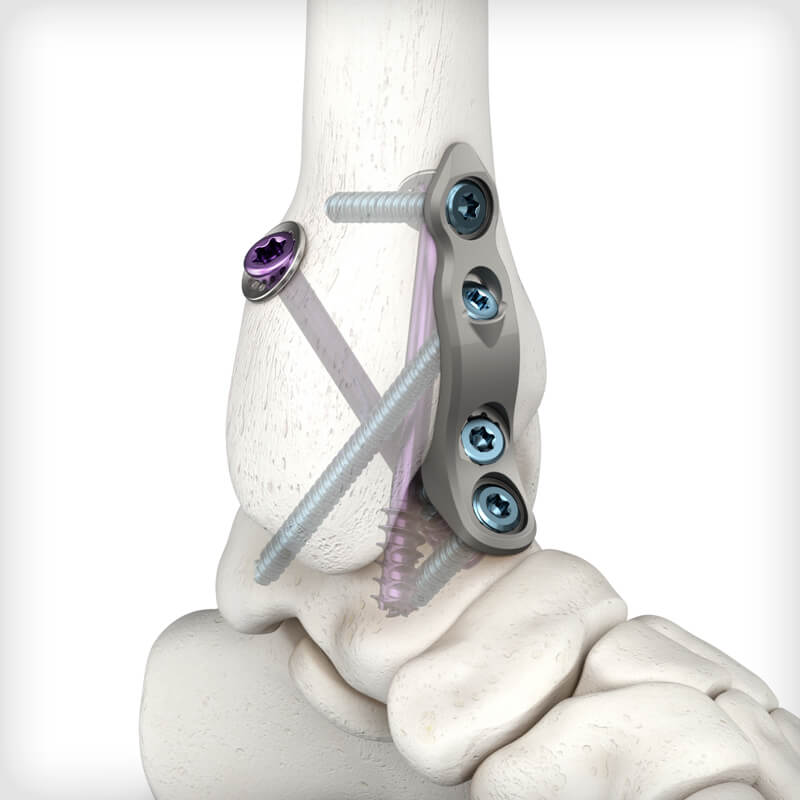 Petite Inline Plates