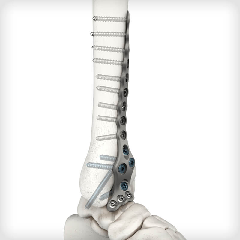 Pilon Primary Fusion Plates