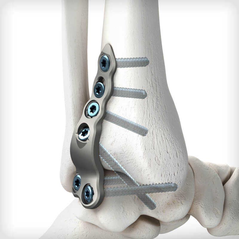 Posterior TT Fusion Plates