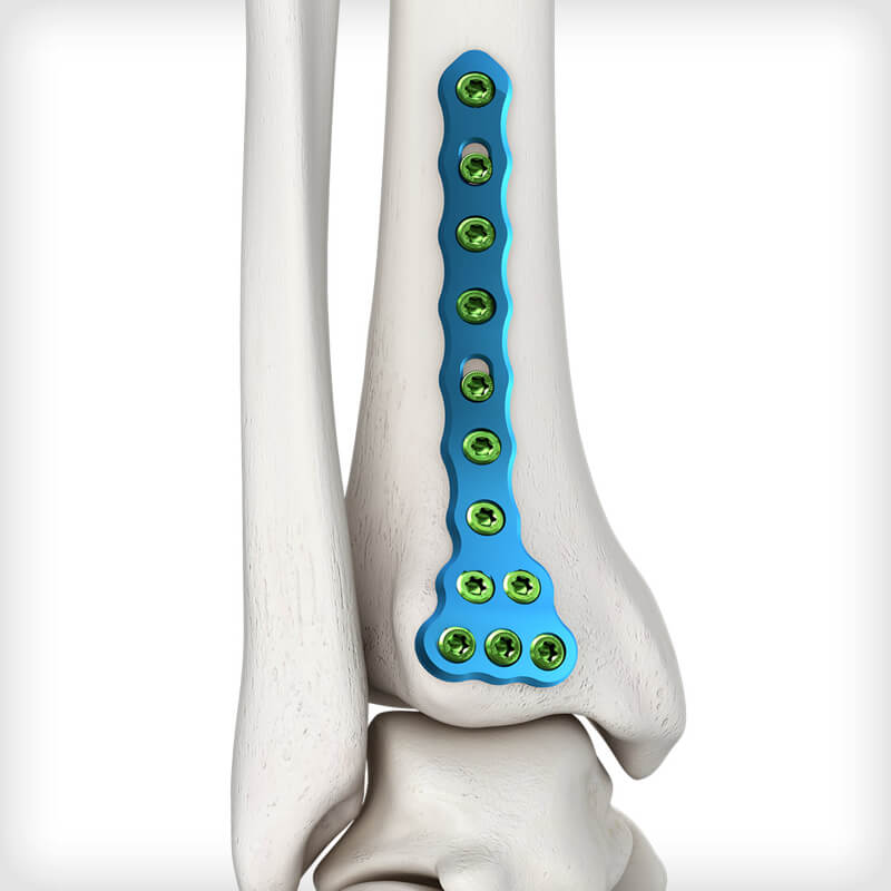Posterolateral Distal Tibia Plates
