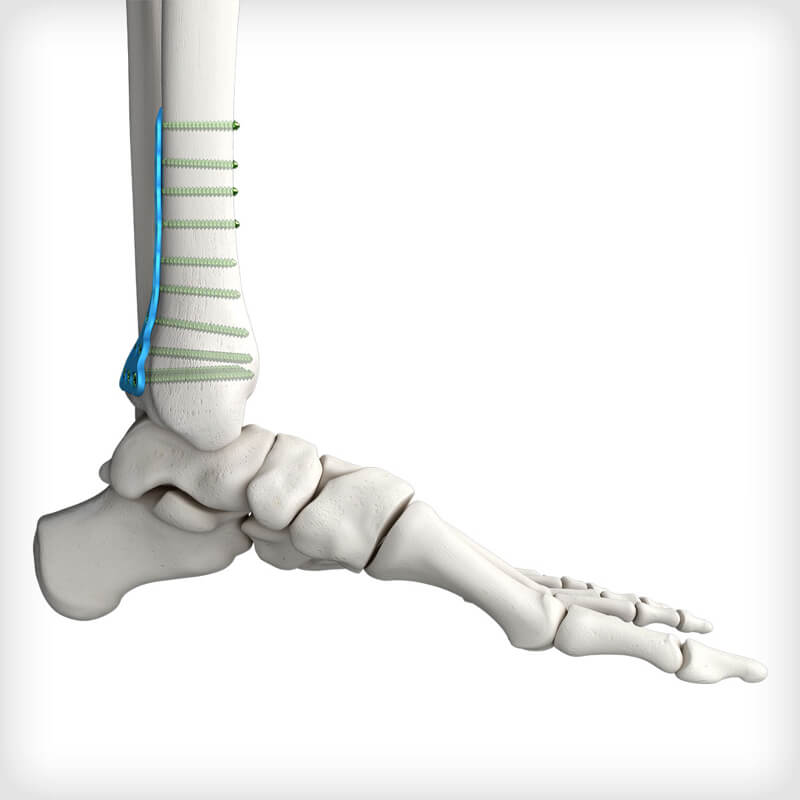 Posterolateral Distal Tibia Plates