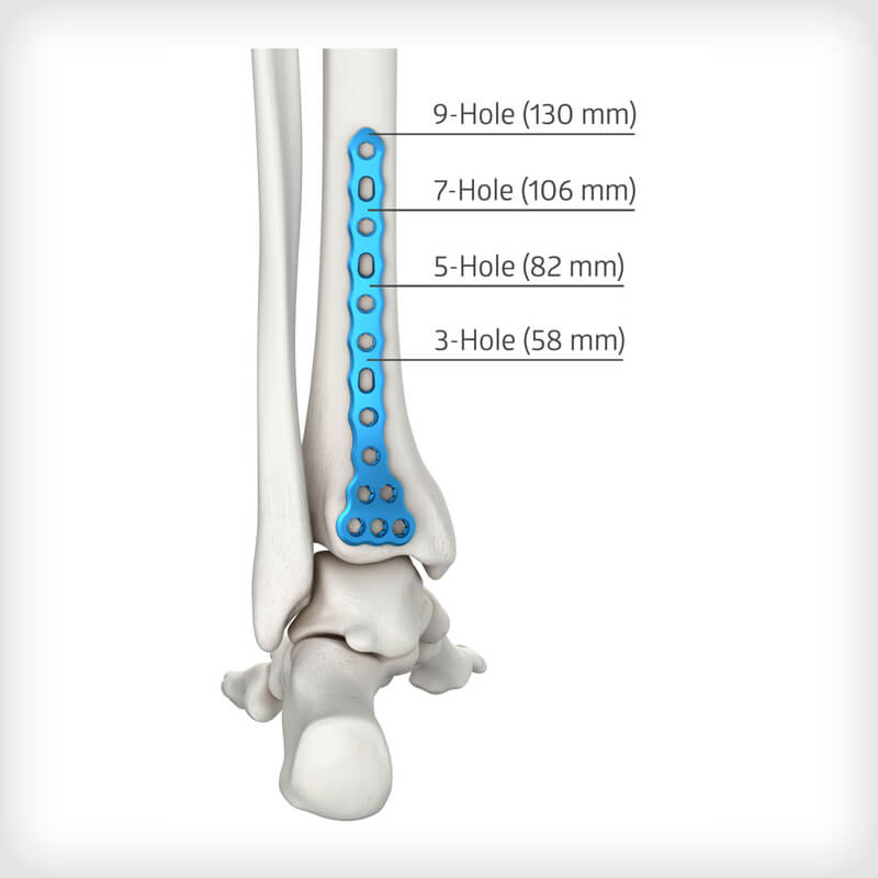 Posterolateral Distal Tibia Plates