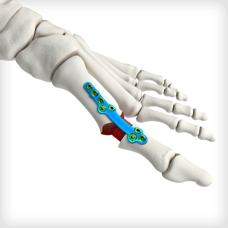 Pre-hydrated MTP Revision Bioimplants