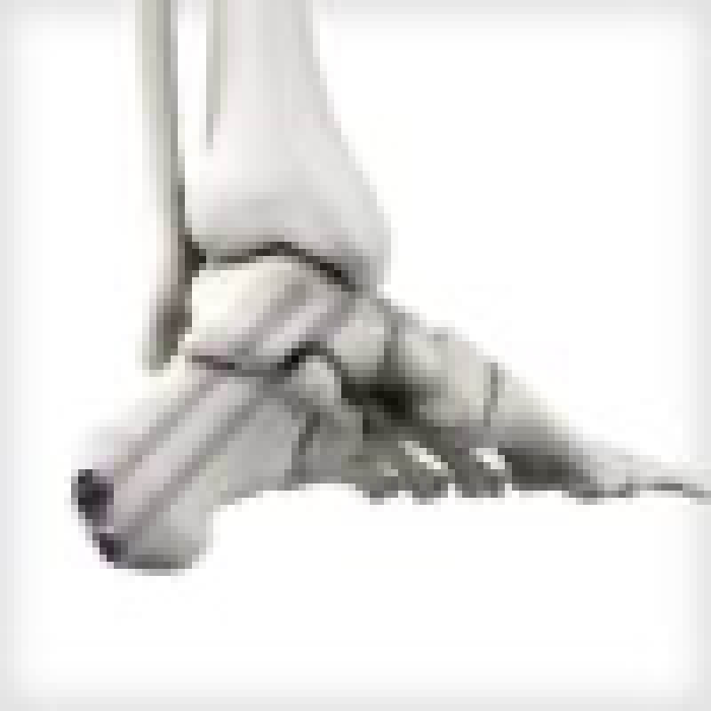 REFLEX Nitinol Dynamic Discs