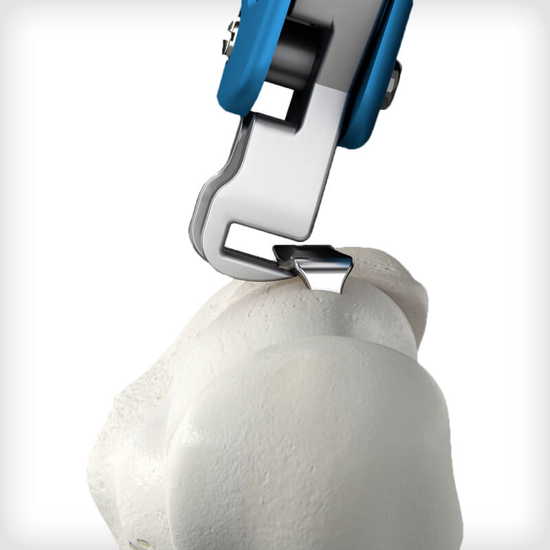 REFLEX Nitinol Staples