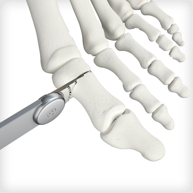 REFLEX Nitinol Staples