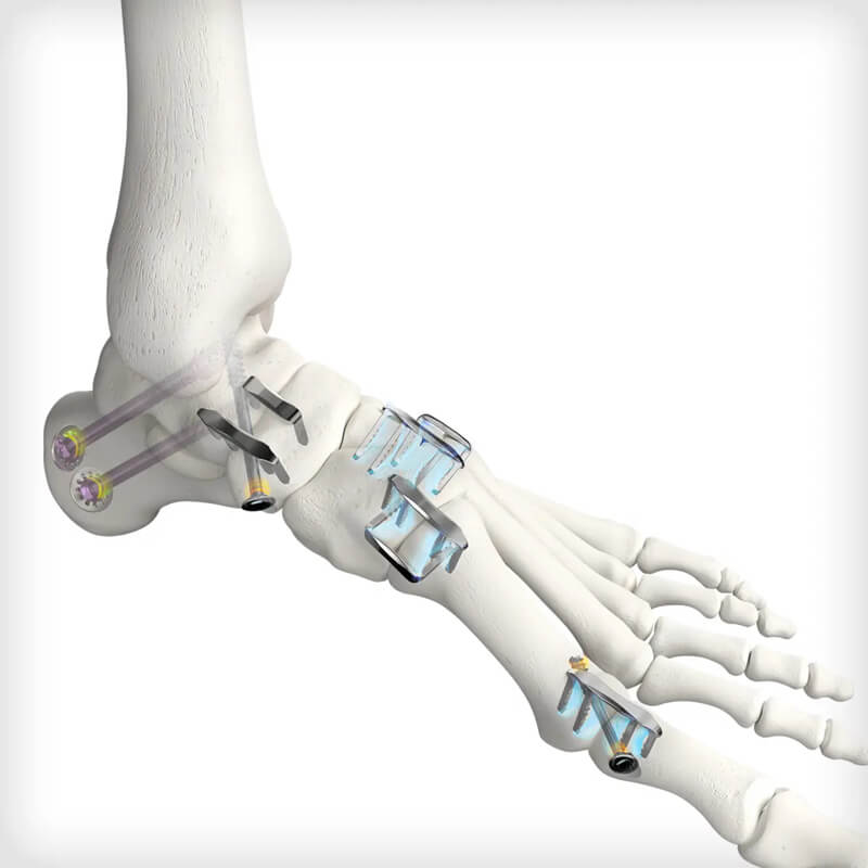 REFLEX TETRA Nitinol Staples