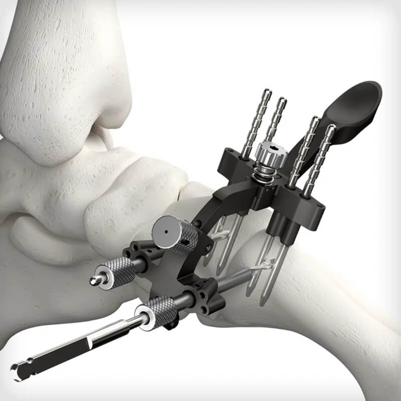 REFLEX TETRA Nitinol Staples