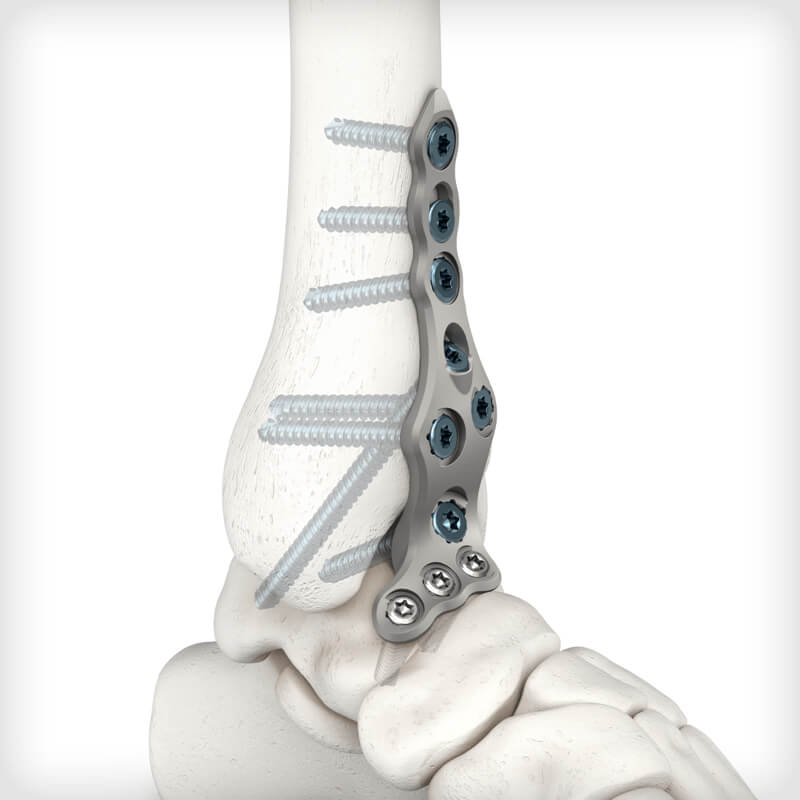 Standard Anterior Plates