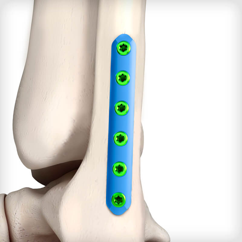 Straight Tibia-Fibula Plates