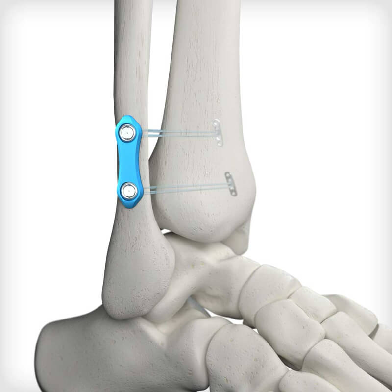 Syndesmosis Buttress Plates