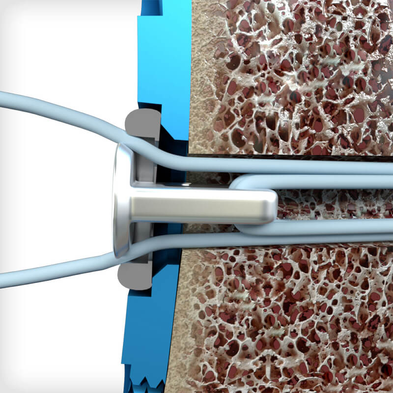 Syndesmosis Buttress Plates