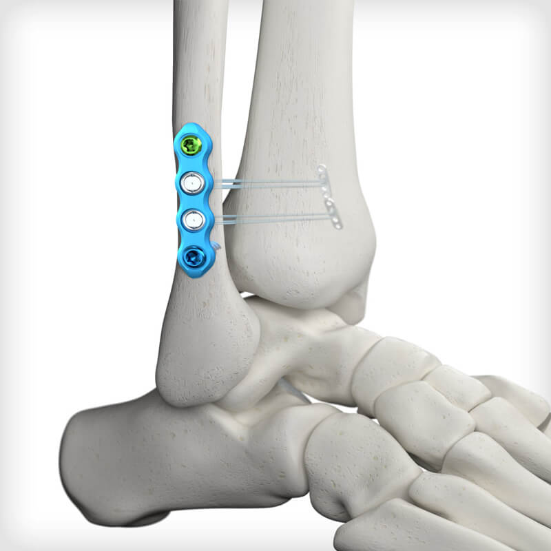 SYNDEX with Constrictor Technology