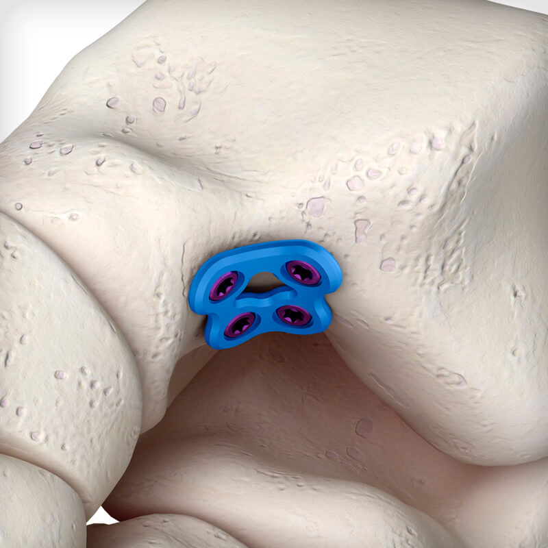 Talar Neck Fracture Plate