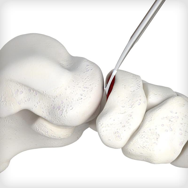 TNC Extension Revision Plate